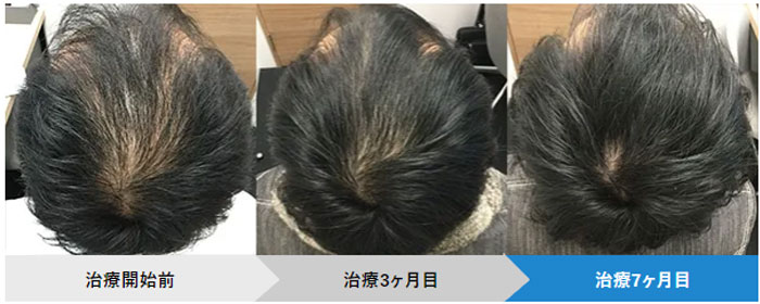 AGAヘアクリニックでの治療事例