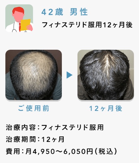 Oops HAIR(ウープス ヘア)での治療過程がこちら！case1