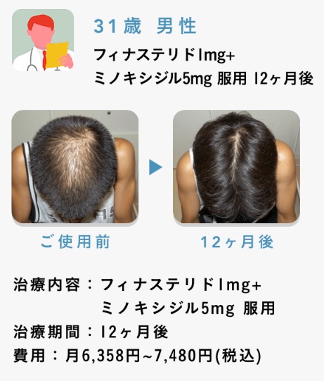 Oops HAIR(ウープス ヘア)での治療過程がこちら！case2