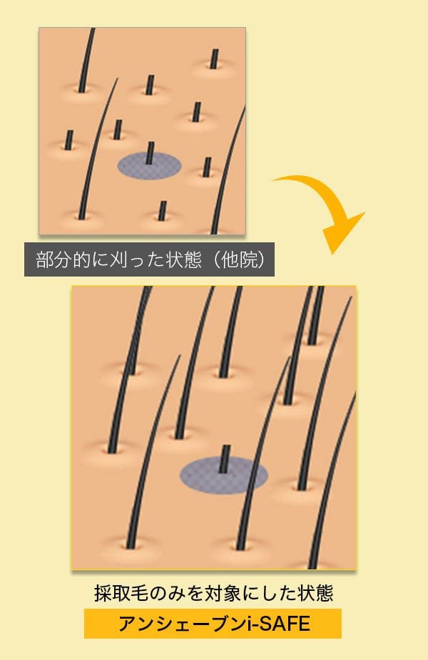 刈り上げない自毛植毛